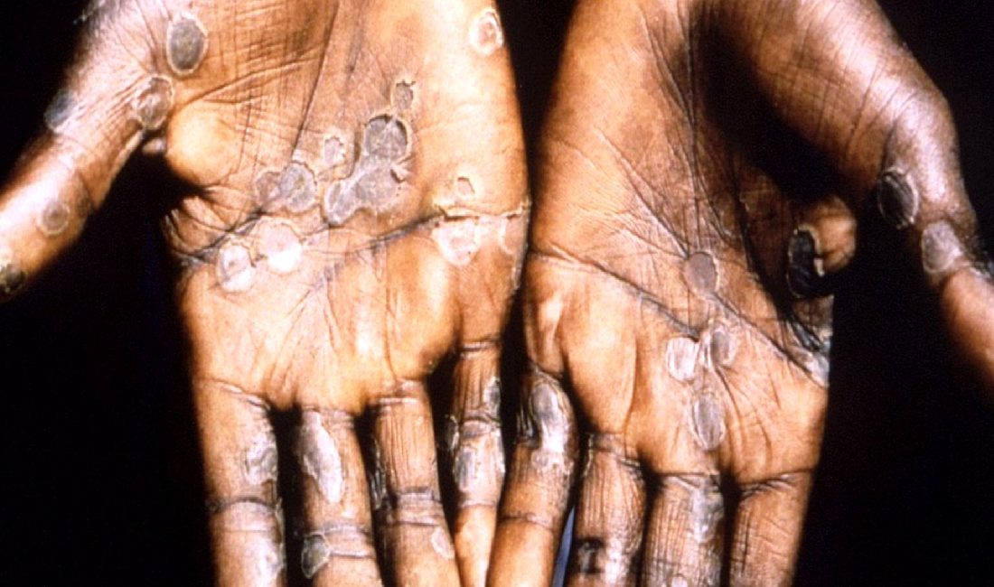 DSÖ, maymun çiçeği virüsünün yayılmasını önlemek amacıyla küresel halk sağlığı