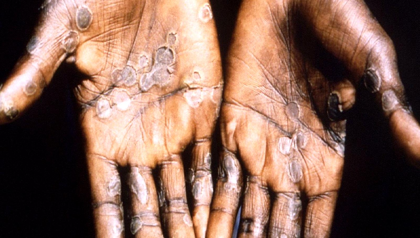 DSÖ, maymun çiçeği virüsünün yayılmasını önlemek amacıyla küresel halk sağlığı