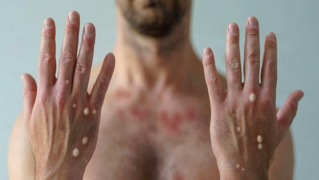 Dünya Sağlık Örgütü’nden Mpox Vakası Duyurusu Dünya Sağlık Örgütü, Mpox vakalarının artışıyla ilgili önemli bir duyuru