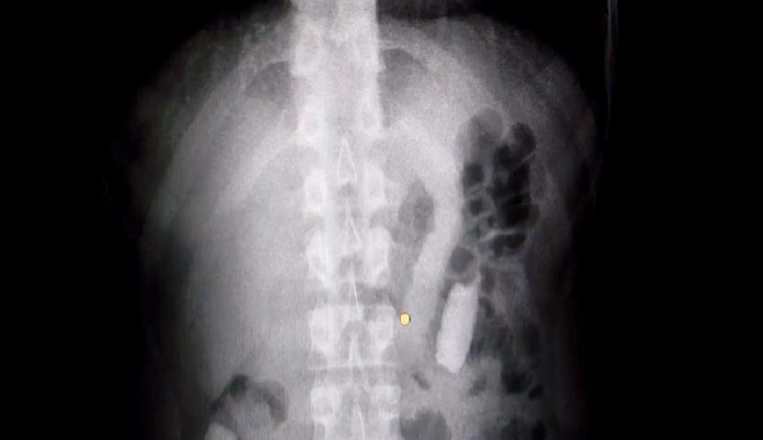 Kayseri’de Uyuşturucu Operasyonu: 1 Kilo 134 Gram Afyon Sakızı Ele Geçirildi Kayseri'de düzenlenen uyuşturucu operasyonunda, 1 kilo 134 gram afyon sakızı