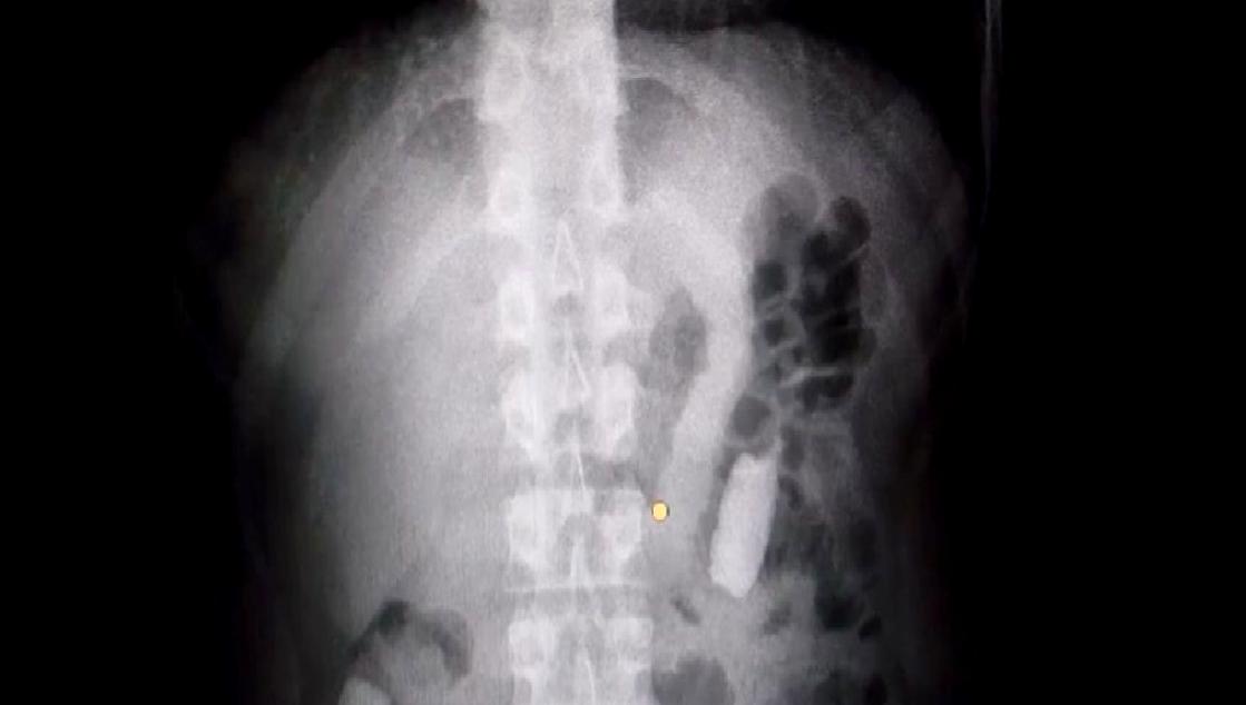 Kayseri'de düzenlenen uyuşturucu operasyonunda, 1 kilo 134 gram afyon sakızı