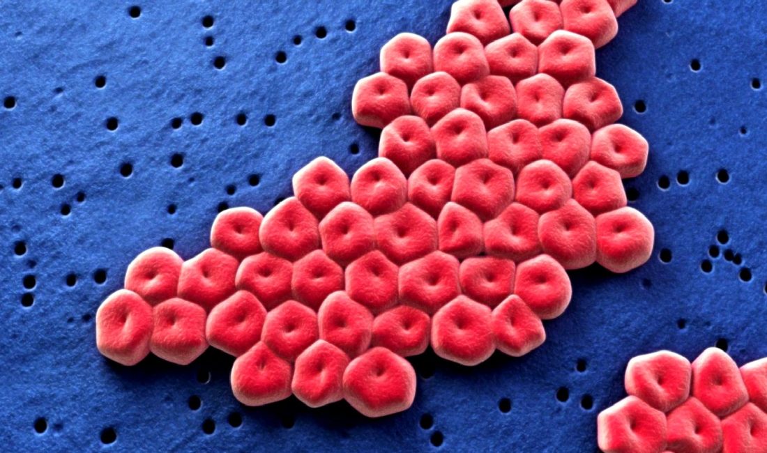 Shrewsbury ve Telford Hastanesi'nde nekrotizan fasiit vakalarını keşfedin. Belirtiler, tedavi