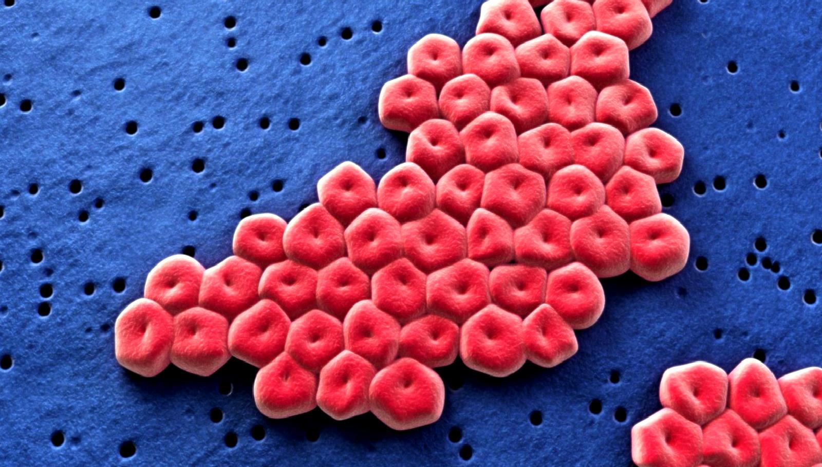 Shrewsbury ve Telford Hastanesi'nde nekrotizan fasiit vakalarını keşfedin. Belirtiler, tedavi