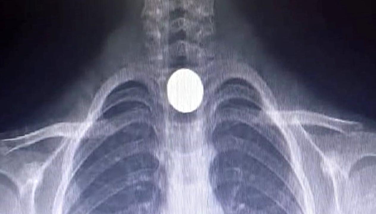 Yusuf Z.'nin yemek borusuna para kaçması, endişeli anlar yaşattı. Olayın