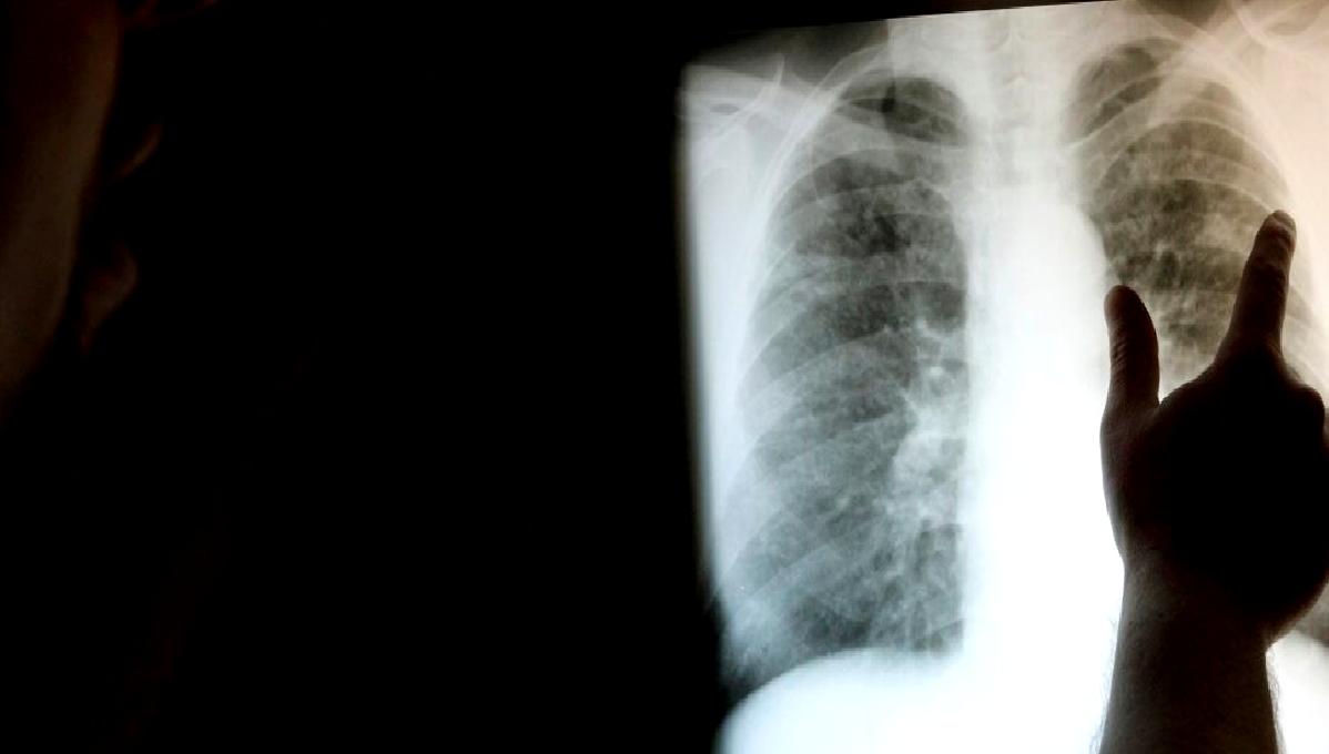 Dünya Astım Günü ile solunum yolu hastalıklarına dikkat çekiyor, farkındalık