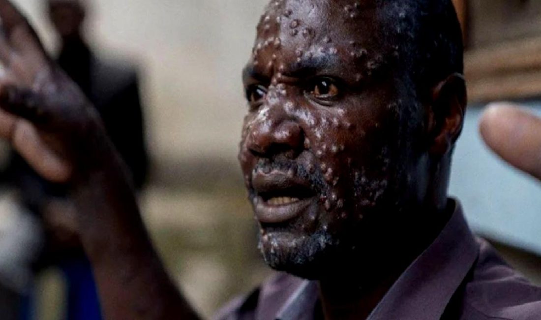 Sierra Leone'de M Çiçeği salgını ve kıtadaki güncel durumu detaylarıyla