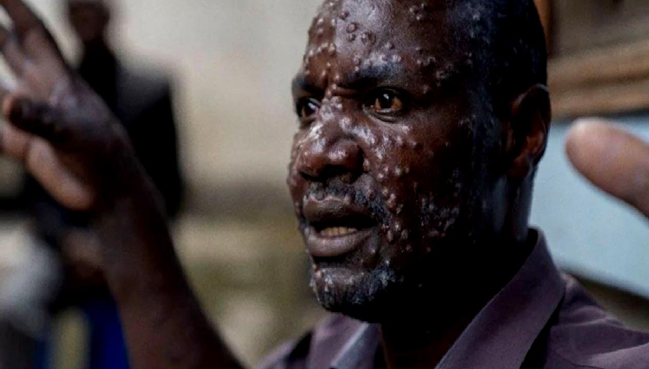 Sierra Leone'de M Çiçeği salgını ve kıtadaki güncel durumu detaylarıyla