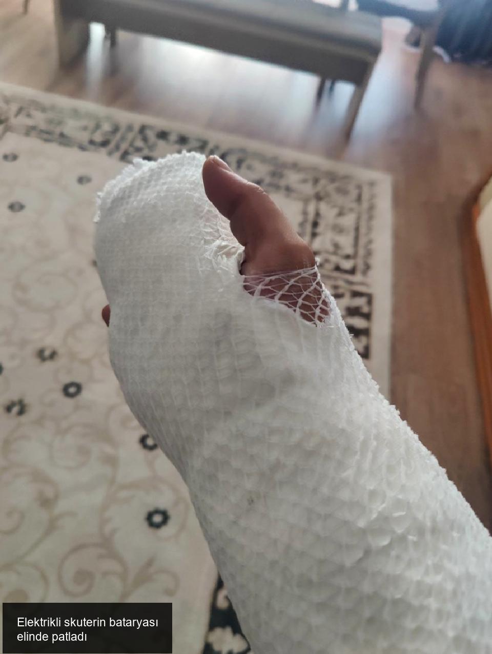 Elektrikli skuterin bataryası elinde patladı